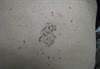 Derm Dx: A cluster of moles on a man's back Derm Dx: A cluster of moles on a man's back