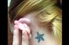 Derm Dx: A growth behind the ear with straw-colored fluid Derm Dx: A growth behind the ear with straw-colored fluid