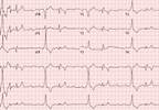 Case Study: Syncope, Dizziness, and Fatigue on a Camping Trip Case Study: Syncope, Dizziness, and Fatigue on a Camping Trip