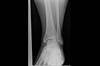Ortho Dx: Medication-induced tendinopathy Ortho Dx: Medication-induced tendinopathy