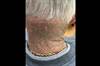 Image of the Week: Blue-black discoloration on the neck and face Image of the Week: Blue-black discoloration on the neck and face
