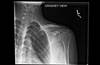 Ortho Dx: Treatment for a greater tuberosity fracture Ortho Dx: Treatment for a greater tuberosity fracture