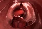 Case Study: Chest Pain and Shortness of Breath in a Patient with Colorectal Cancer Case Study: Chest Pain and Shortness of Breath in a Patient with Colorectal Cancer