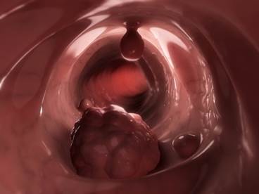 Anemia Criteria Assist Decision on Type of Colorectal Cancer Screen Anemia Criteria Assist Decision on Type of Colorectal Cancer Screen