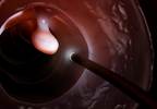 Colorectal cancer risk in veterans significantly reduced with colonoscopy screening Colorectal cancer risk in veterans significantly reduced with colonoscopy screening