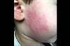 Derm Dx: A sudden, blotchy rash on the cheeks Derm Dx: A sudden, blotchy rash on the cheeks