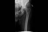 Ortho Dx: Posterior hip dislocation after an accident Ortho Dx: Posterior hip dislocation after an accident