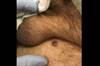 Derm Dx: A dome-shaped growth on the upper thigh Derm Dx: A dome-shaped growth on the upper thigh