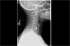 Ortho Dx: Shoulder pain radiating into the biceps Ortho Dx: Shoulder pain radiating into the biceps