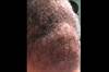 Derm Dx: A large mass on the scalp Derm Dx: A large mass on the scalp