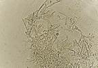 Case Study in Diabetes: Fungal Infections Case Study in Diabetes: Fungal Infections