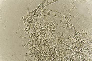 Case Study in Diabetes: Fungal Infections Case Study in Diabetes: Fungal Infections