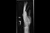 Ortho Dx: Thumb pain and swelling after a tumbling injury Ortho Dx: Thumb pain and swelling after a tumbling injury