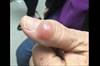 Derm Dx: A large lesion on the thumb Derm Dx: A large lesion on the thumb