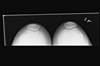 Ortho Dx: Knee pain over the lateral patellofemoral facet joint Ortho Dx: Knee pain over the lateral patellofemoral facet joint