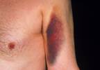 Oral Anticoagulation: Reversing the Current View in Bleeding Events Oral Anticoagulation: Reversing the Current View in Bleeding Events