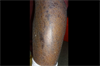 Derm Dx: Xerosis with a fish scale pattern Derm Dx: Xerosis with a fish scale pattern