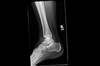 Ortho Dx: Neck fracture and loss of bone mineral density Ortho Dx: Neck fracture and loss of bone mineral density