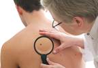 Chronic Aspirin Exposure Linked to Melanoma Risk in Males Chronic Aspirin Exposure Linked to Melanoma Risk in Males