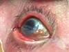 Image of the Week: A thin white film on the cornea after COPD diagnosis Image of the Week: A thin white film on the cornea after COPD diagnosis