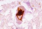 Amyotrophic Lateral Sclerosis: Update for the Primary Care Clinician Amyotrophic Lateral Sclerosis: Update for the Primary Care Clinician