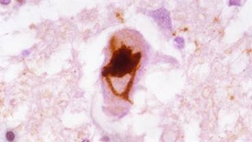 Amyotrophic Lateral Sclerosis: Update for the Primary Care Clinician Amyotrophic Lateral Sclerosis: Update for the Primary Care Clinician