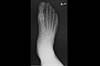 Ortho Dx: Toe pain in a runner Ortho Dx: Toe pain in a runner