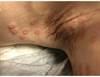 Derm Dx: A sudden, blistering rash Derm Dx: A sudden, blistering rash