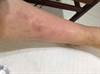 Image of the Week: Severe abdominal pain and a swollen knee in a young female Image of the Week: Severe abdominal pain and a swollen knee in a young female
