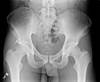 Ortho Dx: Chronic hip pain after a soccer injury Ortho Dx: Chronic hip pain after a soccer injury