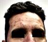 Derm Dx: A rapidly spreading rash and fever Derm Dx: A rapidly spreading rash and fever
