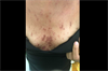 Image of the Week: Headache and a rash on the trunk and extremities Image of the Week: Headache and a rash on the trunk and extremities