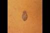 Derm Dx: A growth on the armpit Derm Dx: A growth on the armpit