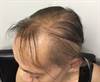 Derm Dx: Abrupt onset of hair loss Derm Dx: Abrupt onset of hair loss