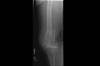 Ortho Dx: Leg pain after a fall in an elderly woman Ortho Dx: Leg pain after a fall in an elderly woman