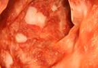Budesonide ER for Ulcerative Colitis Safe Regardless of Gender, Age Budesonide ER for Ulcerative Colitis Safe Regardless of Gender, Age