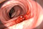 Patients With Gout Have Lower Prevalence of Colorectal Cancer Patients With Gout Have Lower Prevalence of Colorectal Cancer