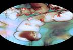 More NPs Ordering Multitarget Stool DNA Test for Colorectal Cancer Screening More NPs Ordering Multitarget Stool DNA Test for Colorectal Cancer Screening