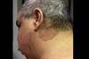 Derm Dx: A moderately itchy rash on the neck and cheek Derm Dx: A moderately itchy rash on the neck and cheek