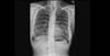 Image of the Week: Persistent cough and sputum in a 75-year-old woman Image of the Week: Persistent cough and sputum in a 75-year-old woman