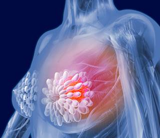 The number of women with breast implant-associated anaplastic large cell lymphoma (BIA-ALCL) now stands at 457, compared with 414 in the last report. The number of women with breast implant-associated anaplastic large cell lymphoma (BIA-ALCL) now stands at 457, compared with 414 in the last report.
