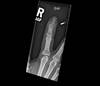 Ortho Dx: A Persistent Finger Infection in a 61-Year-Old Female Ortho Dx: A Persistent Finger Infection in a 61-Year-Old Female
