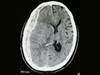 Image of the Week: Progressive headache, dizziness, and confusion in a 76-year-old man Image of the Week: Progressive headache, dizziness, and confusion in a 76-year-old man