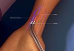 FDA Permits Marketing of Devices to Create Arteriovenous Fistula FDA Permits Marketing of Devices to Create Arteriovenous Fistula
