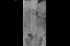 Ortho Dx: Severe Lower Back Pain in an Elderly Woman Ortho Dx: Severe Lower Back Pain in an Elderly Woman
