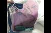 Figure 1 Quiz: A purple urine bag Figure 1 Quiz: A purple urine bag