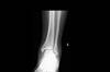 OrthoDx: Syndesmotic Injury Following Football Game OrthoDx: Syndesmotic Injury Following Football Game