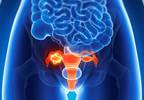 No Difference in CEA vs CA125/CEA Ratio for Identifying Ovarian Masses No Difference in CEA vs CA125/CEA Ratio for Identifying Ovarian Masses