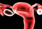 Type 2 Diabetes Risk Up With PCOS Regardless of BMI Type 2 Diabetes Risk Up With PCOS Regardless of BMI