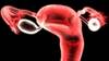 Chemotherapy With Bevacizumab May Improve Some Ovarian Cancer Outcomes, Worsen Others Chemotherapy With Bevacizumab May Improve Some Ovarian Cancer Outcomes, Worsen Others